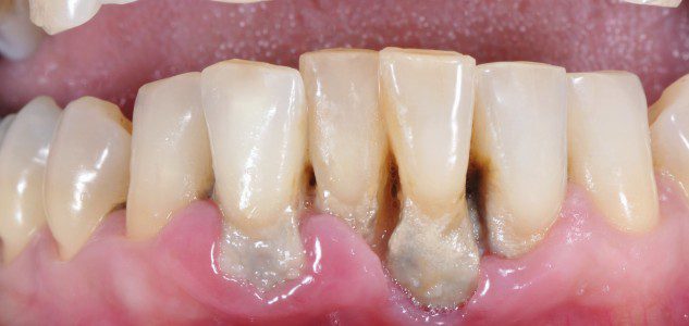 gum-disease-treatment-symptoms-cost-recovery-etc