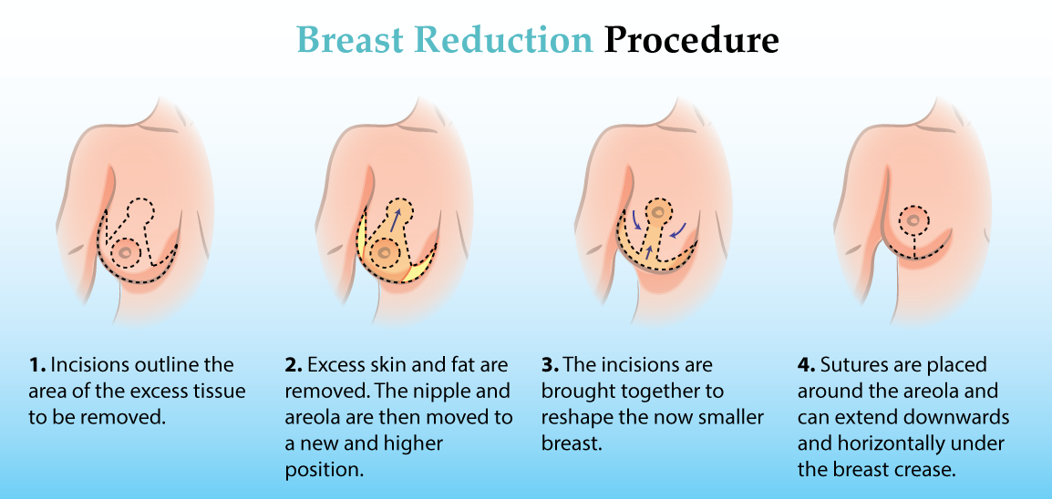 Breast Reduction Surgery Cost Recovery Time Results Etc