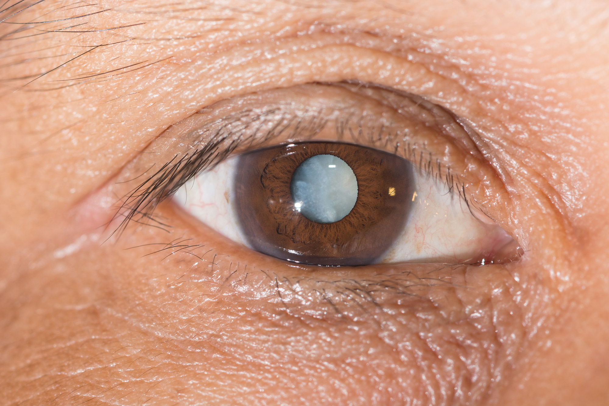 Cost Of Cataract Surgery Treatment Options Recovery Results