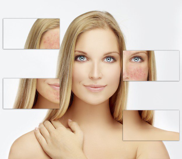 Cost of CO2 Laser Skin Resurfacing - Benefits, Recovery, Results