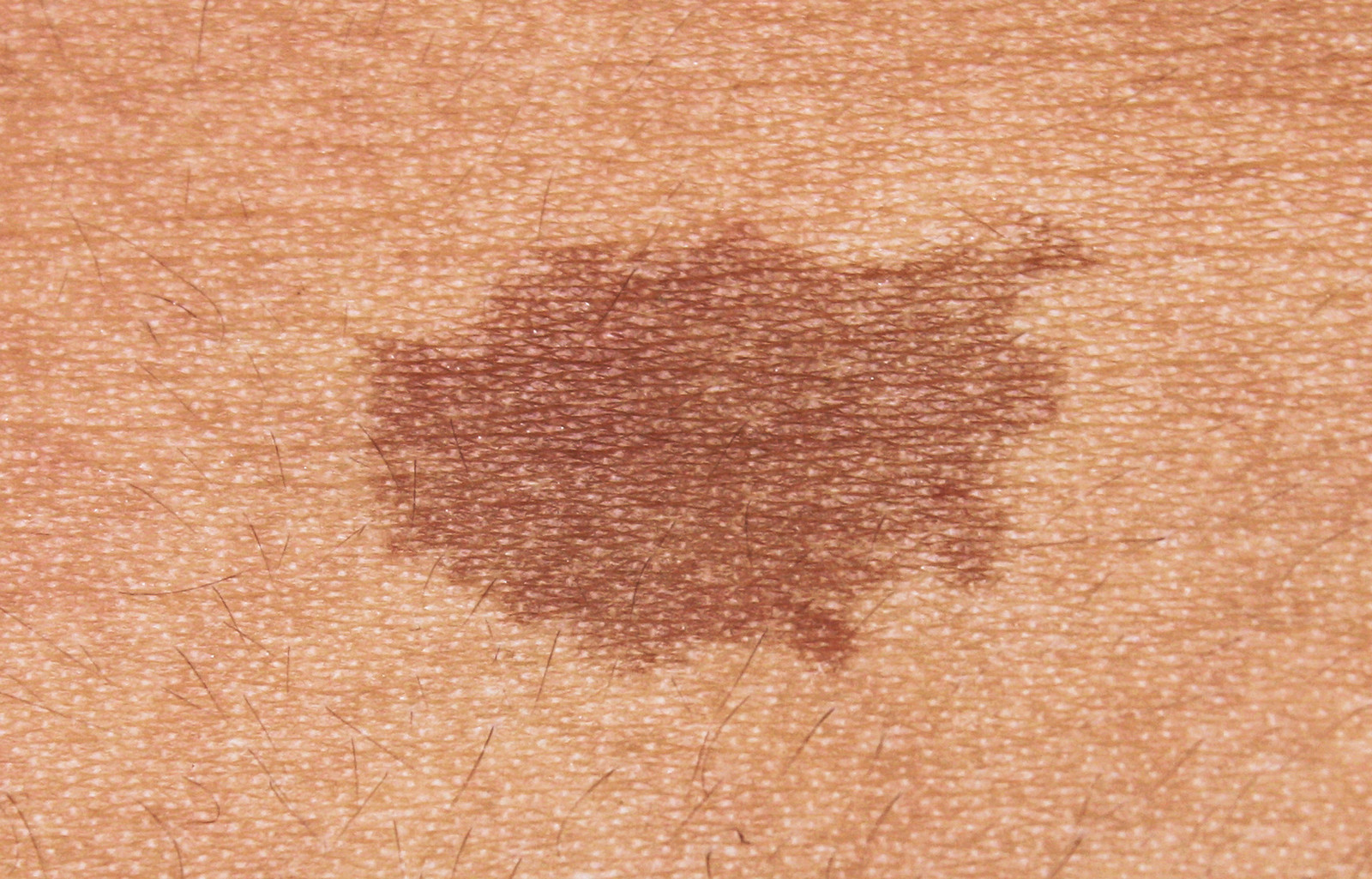 Brown Spots On Skin Arms Hot Sex Picture